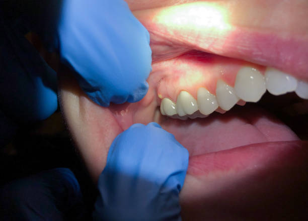 Best Emergency Gum Treatment in Centreville, MS